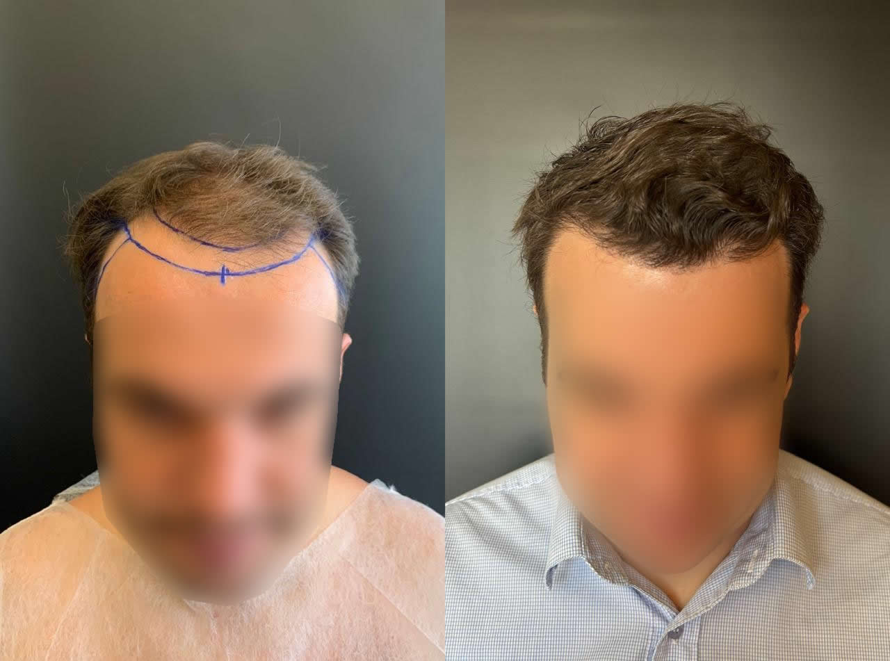Antes e depois do transplante capilar – caso 1