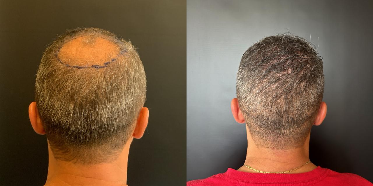 Antes e depois do transplante capilar – caso 2