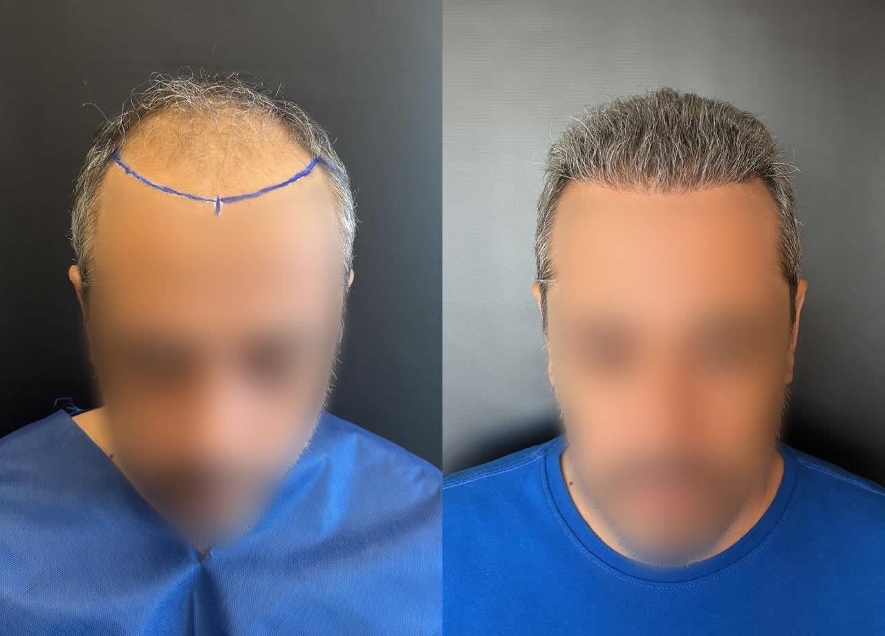 Antes e depois do transplante capilar – caso 11
