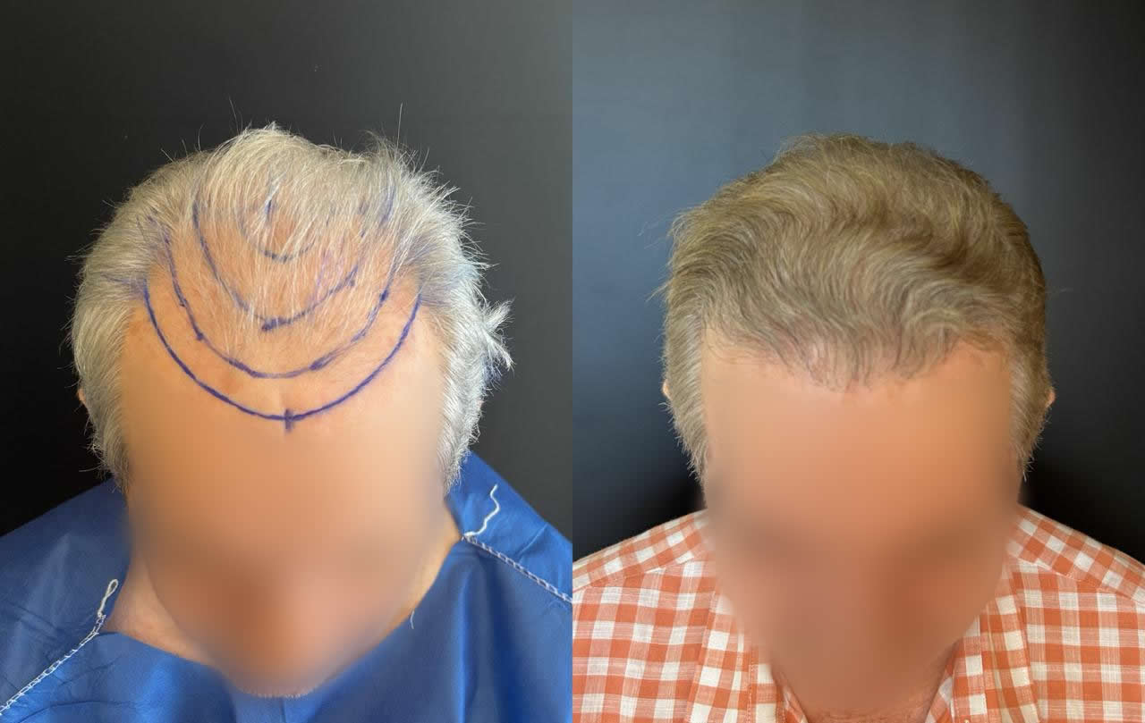 Antes e depois do transplante capilar – caso 3