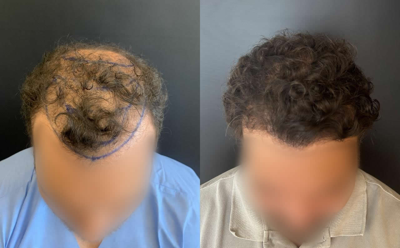 Antes e depois do transplante capilar – caso 4