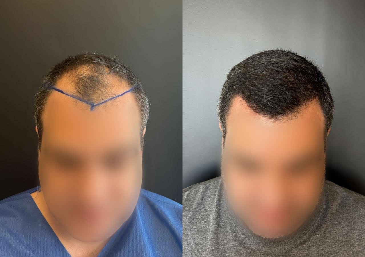 Antes e depois do transplante capilar – caso 8